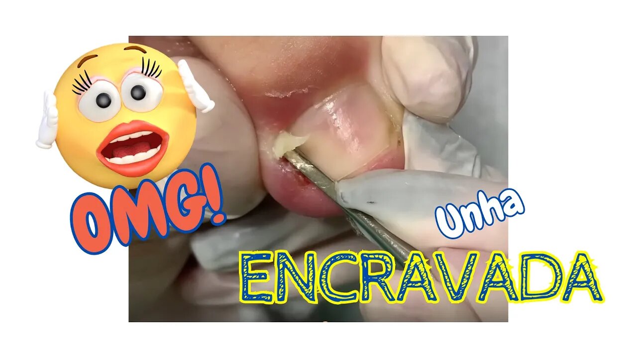 Unha ENCRAVADA que dói muito!!! #unhaencravada #podologia #nails #ingrown_toenail