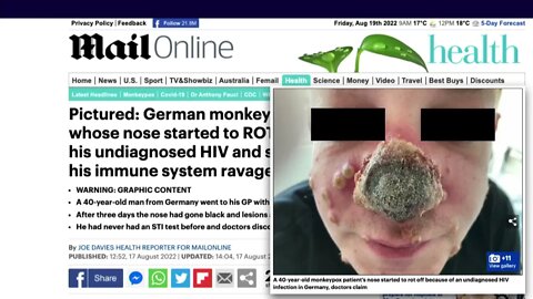 UK Column News - 19th August 2022 - The Monkeypox Grift