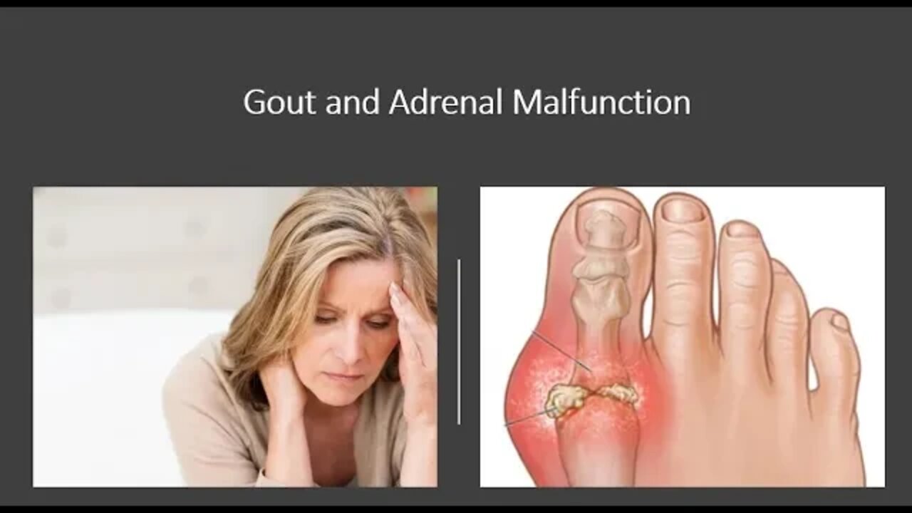 Gout Natural Treatment Options