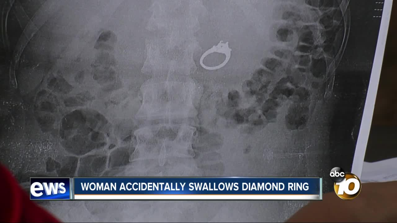 San Diego woman swallows engagement ring while sleeping