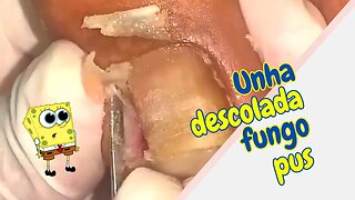 UNHA em TELHA com FUNGO e PUS #unhas #pes #dor #podologia #fungos #procedimento