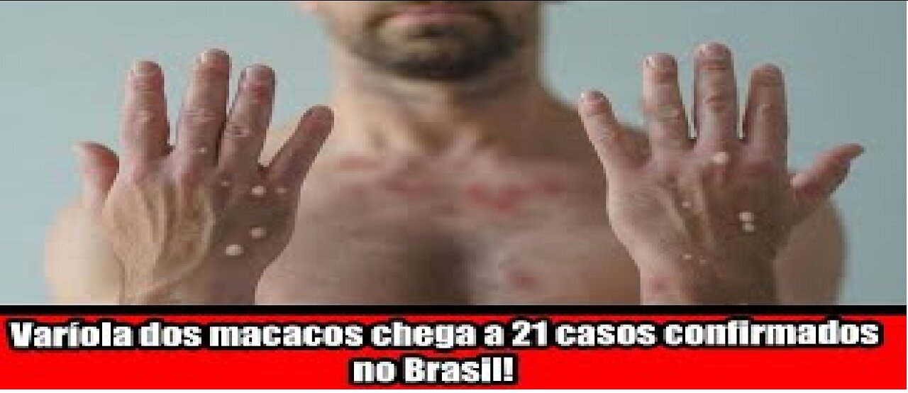 Varíola dos macacos chega a 21 casos confirmados no Brasil