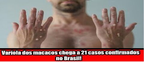 Varíola dos macacos chega a 21 casos confirmados no Brasil