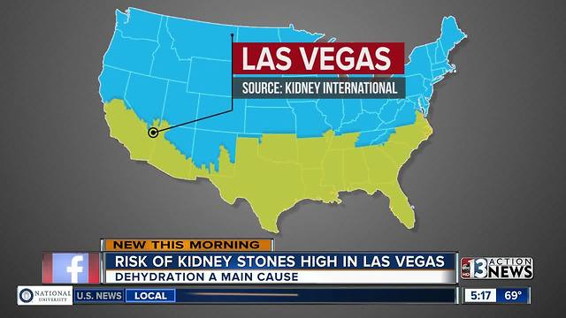 Risk of kidney stones high in Las Vegas