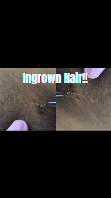Ingrown Hair on the armpit!