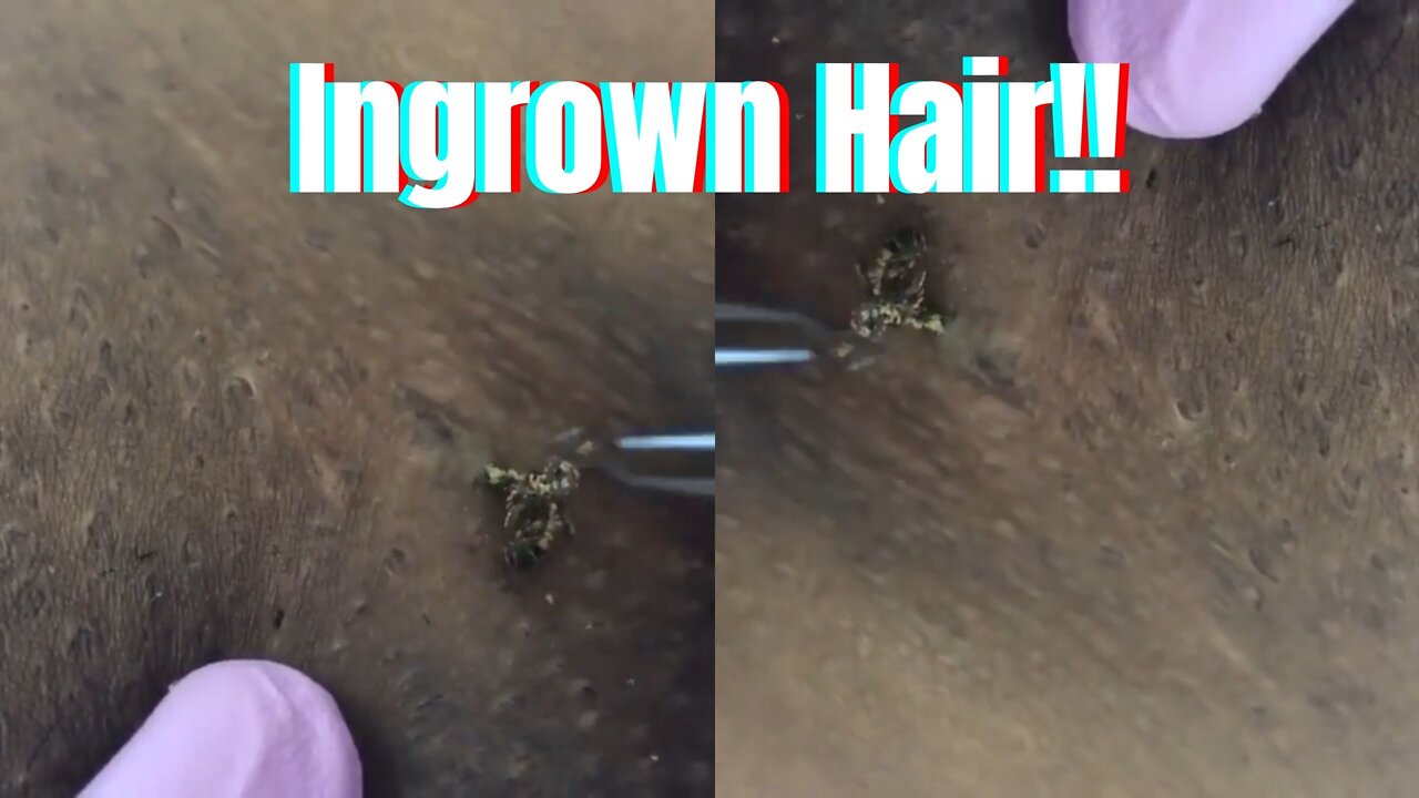 Ingrown Hair on the armpit!