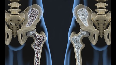 How To Osteoporosis Dr Joel Wallach