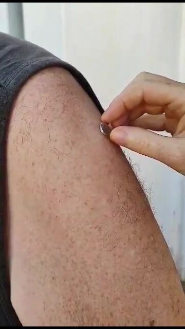 Magnetic Arm after Jab