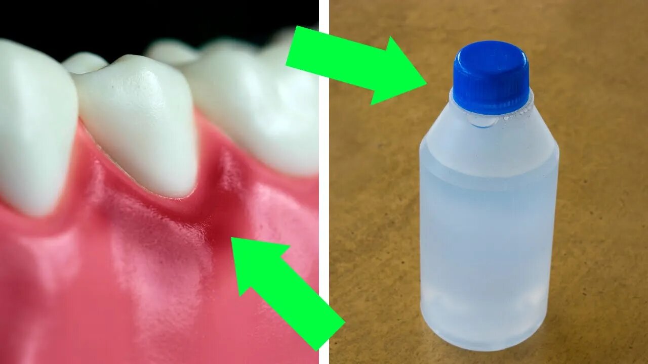 Stop Gingivitis Using An Ingredient You Have In Your Home