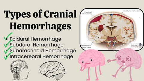 Understanding Types of Cranial Hemorrhage: Epidural, Subdural, Subarachnoid, and Intracerebral