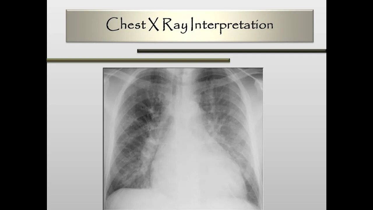 Chest X-Ray Interpretation