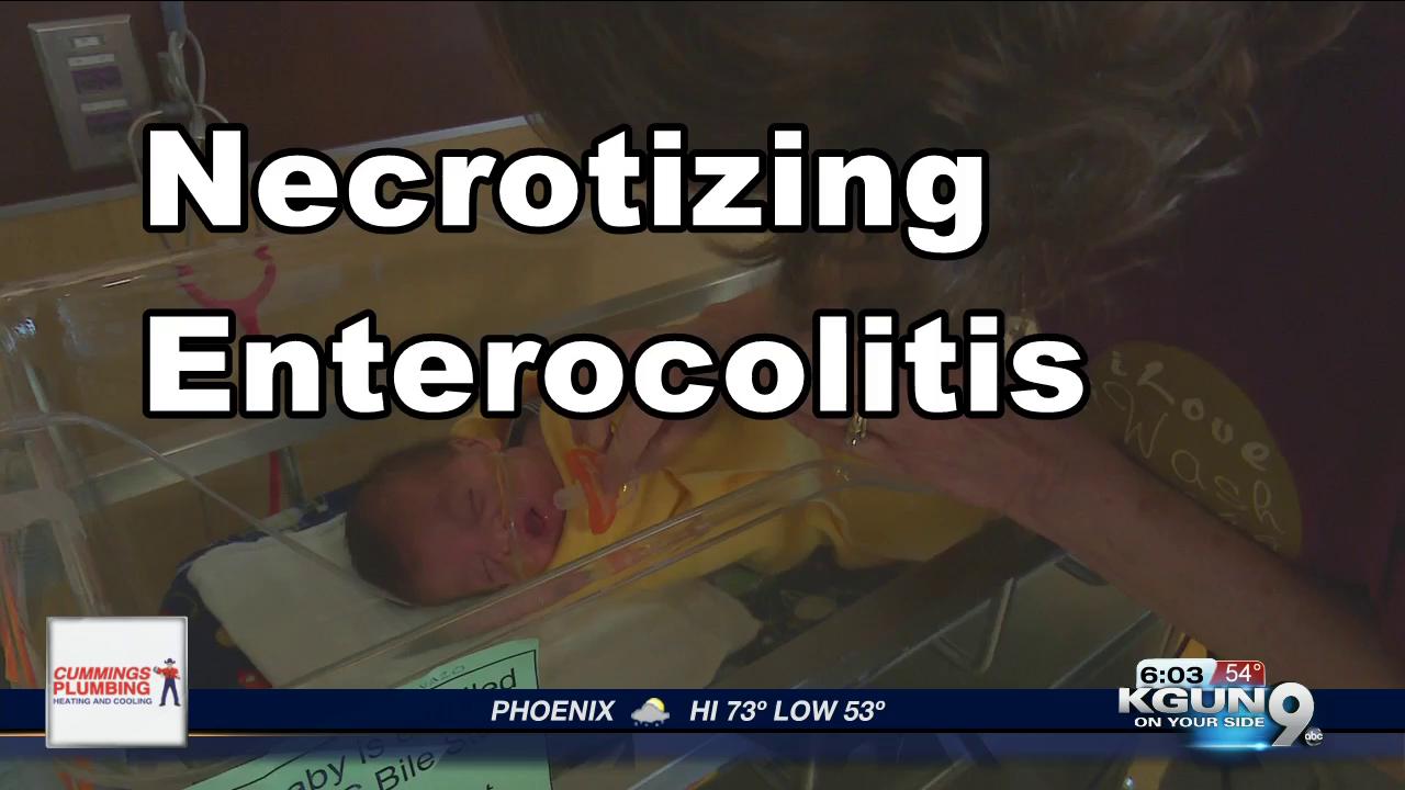 Necrotizing Enterocolitus: A disease in premature babies