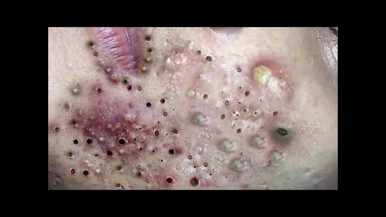 Big Cystic Acne Blackheads Extraction 334