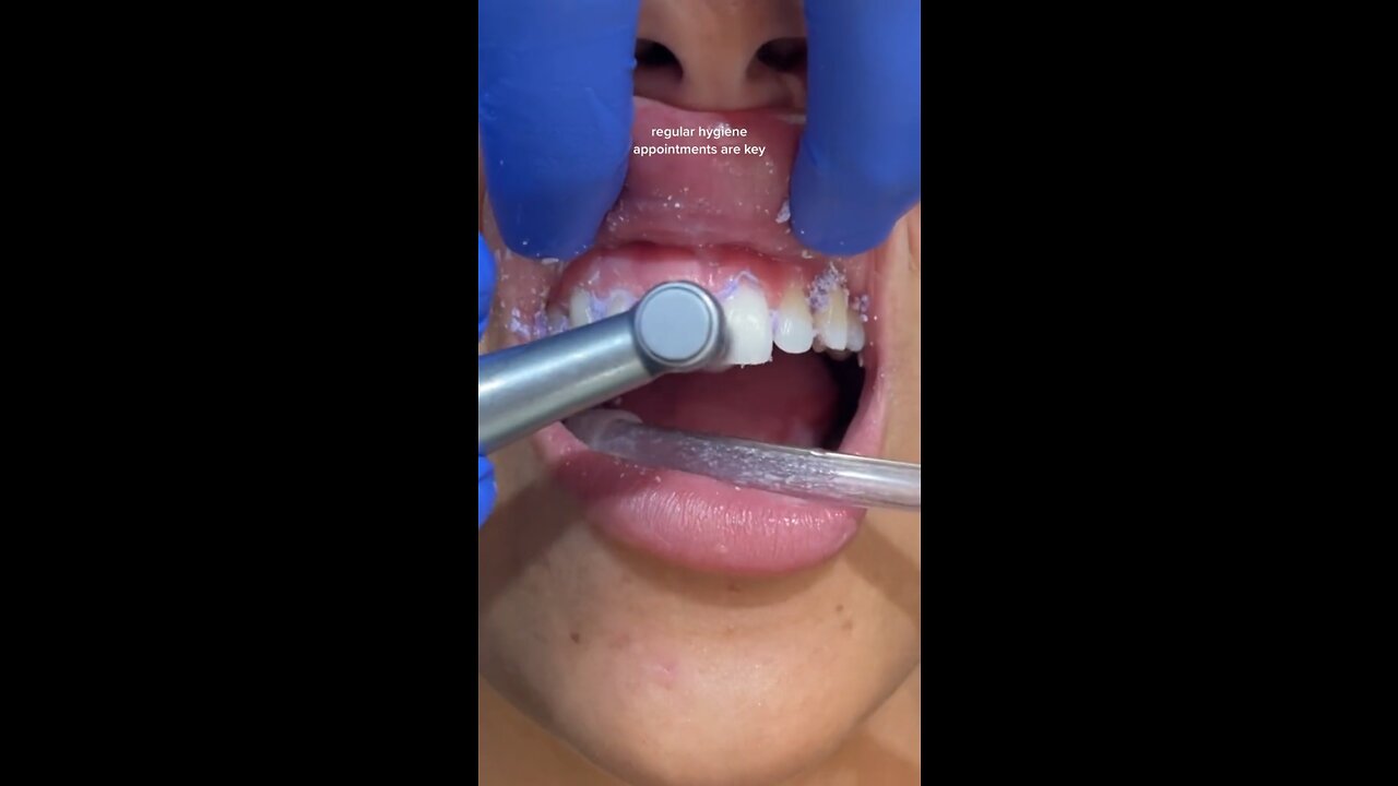 Teeth whitening For Beginners