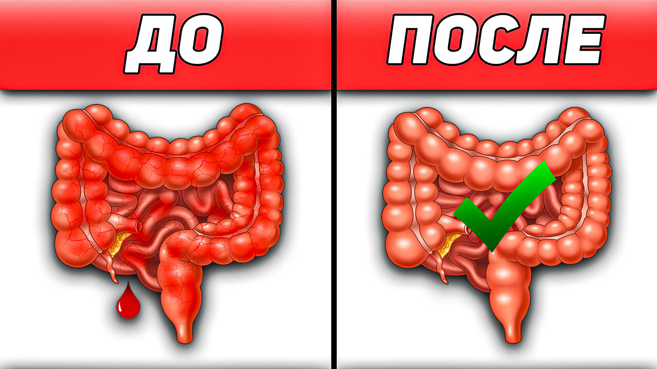 КИШЕЧНИК | Неспецифический язвенный колит лечение