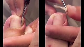 Satisfying Toenail ingrown removal #1