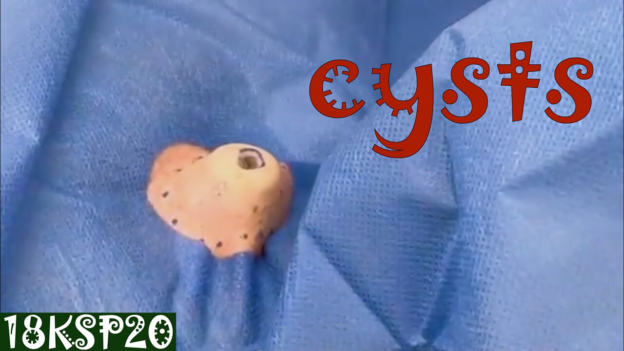 Big Cysts with Much Pus