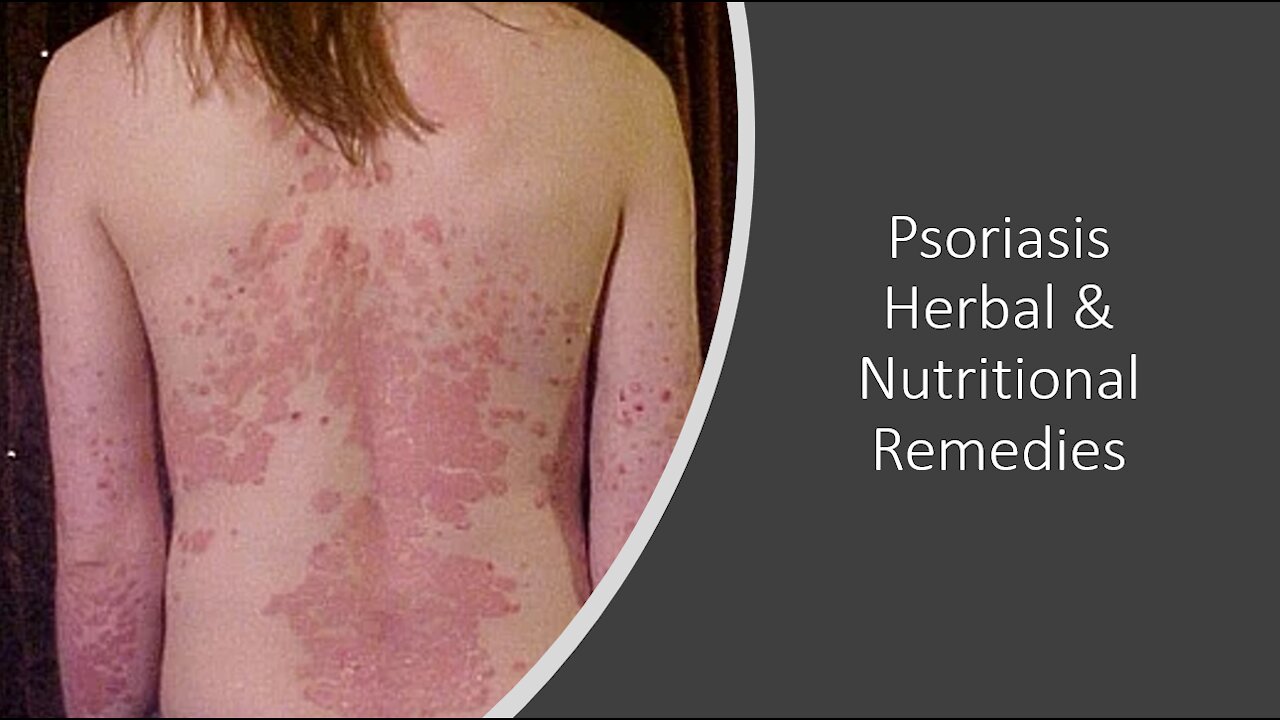 Psoriasis - Supplements, Herbs & Vitamins