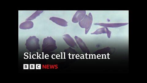 UK approves gene therapy to cure two blood disorders - BBC News