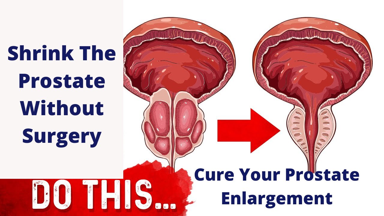 How To Cure Prostate Enlargement