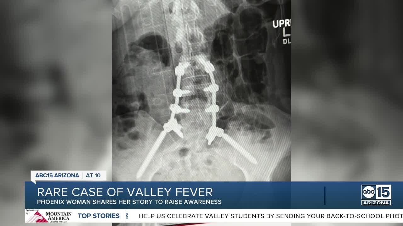 What started as back pain ended up being Valley Fever for one Phoenix woman