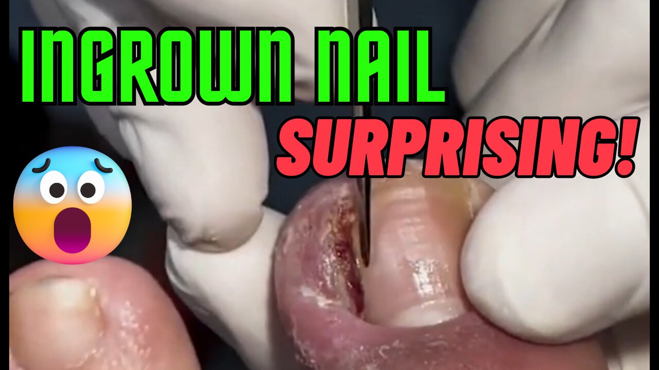 Ingrown Nail - Surprising! 😱 😱