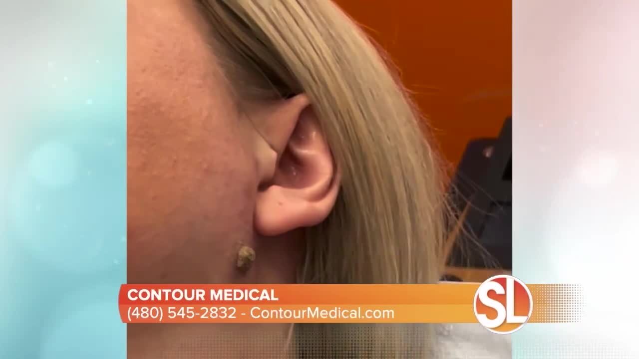 Contour Medical offers scarless mole and skin tag removal