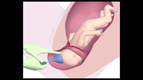 55. Assisted (instrumental) birth - Suction (Ventouse), Forceps