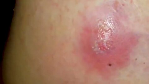Satisfactory Video Blackhead Removal Skin Cleansing #19 | 2022 Video