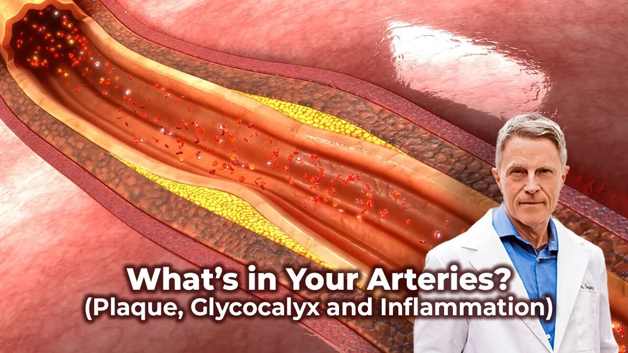 What’s in Your Arteries? (Plaque, Glycocalyx & Inflammation)