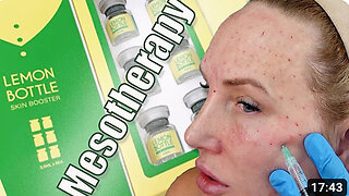 Mesotherapy Tutorial Using LemonBottle Skin Booster