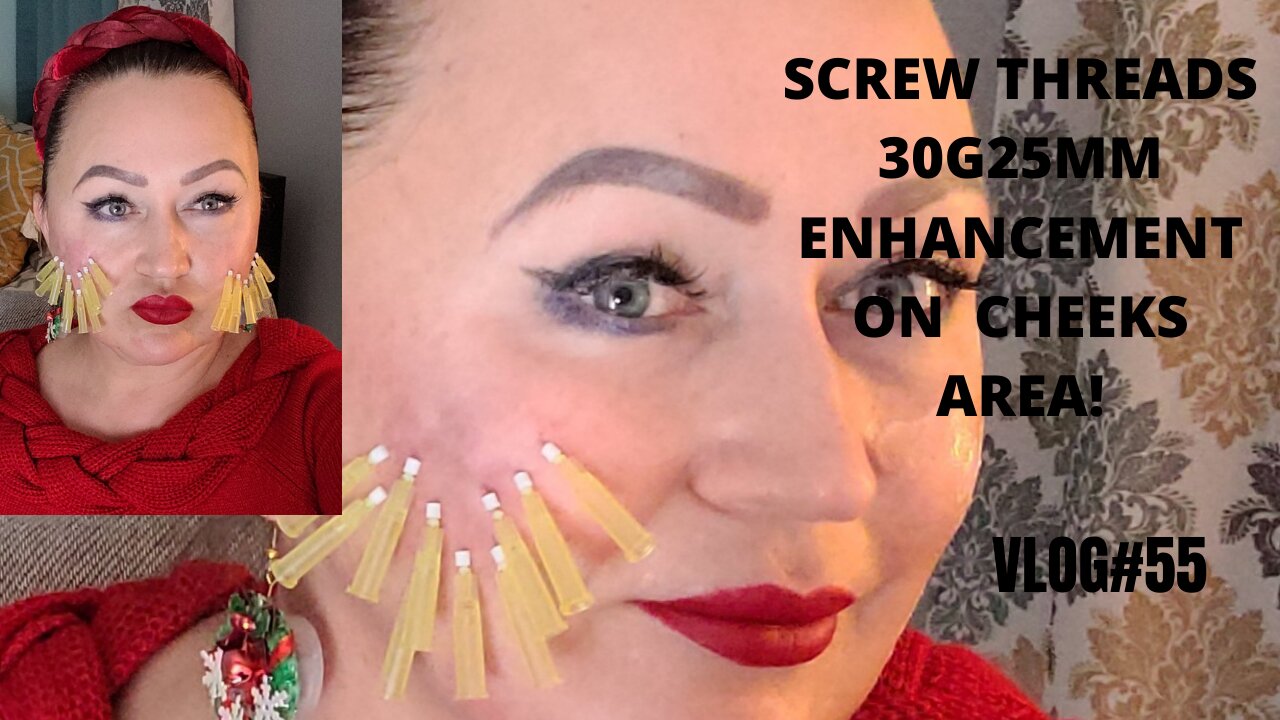 ENHANCEMENT CHEEKS AREA WITH PDO SCREW THREADS 30G 25 MM VLOG#55 12.09.21 #pdothreads #screwthread