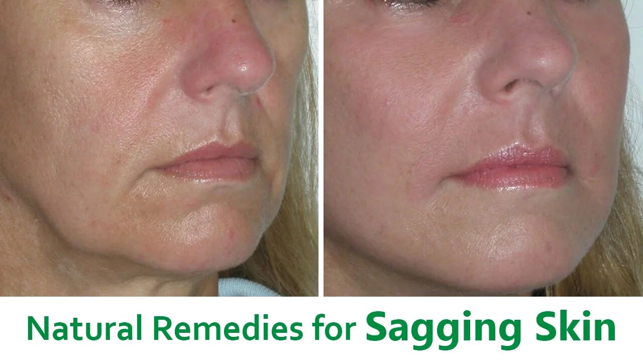 The Best 5 Natural Remedies for Sagging Skin