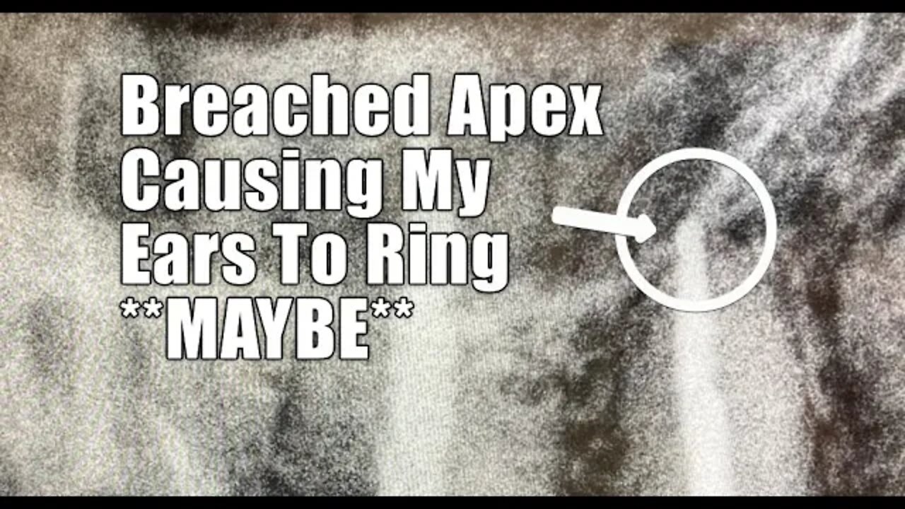 Ringing in my ear SOLVED *maybe* breached apex Juarez #Mexico #Tinnitus