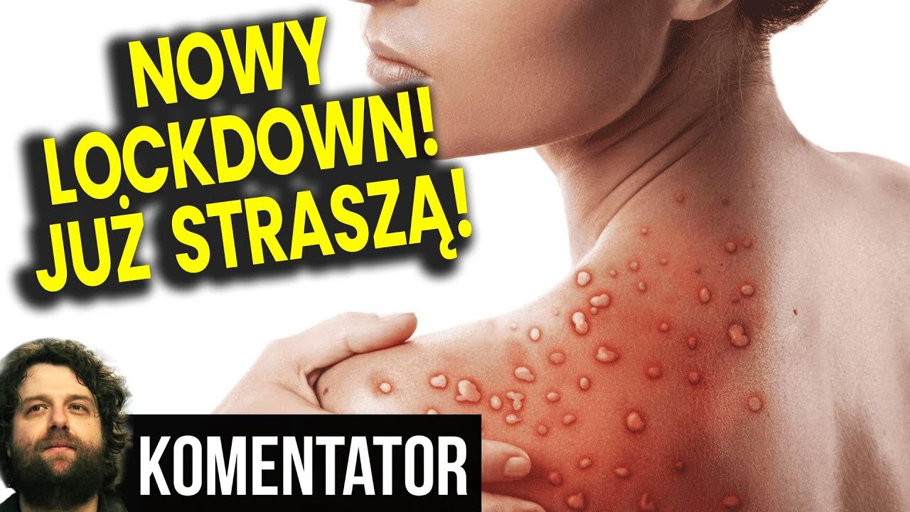 Nowy Lockdown na Jesieni przez Mpox Małpią Ospę? Już Zaczęli Straszyć - Analiza Ator