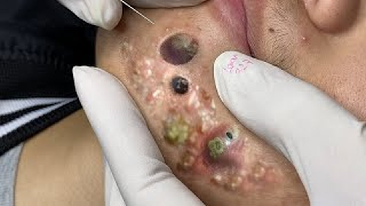 pimple popper, Satisfying blackheads removal and acne treatment on 107