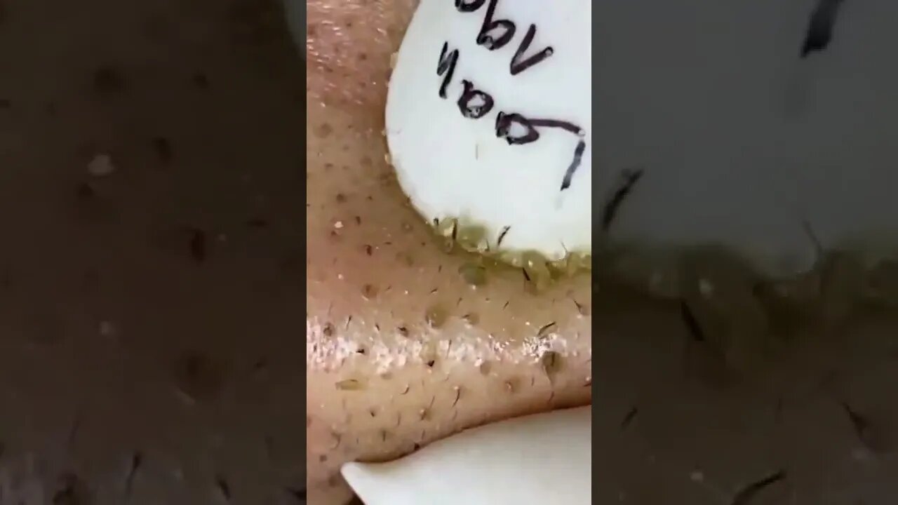 FULL Blackheads Removal from the Nose