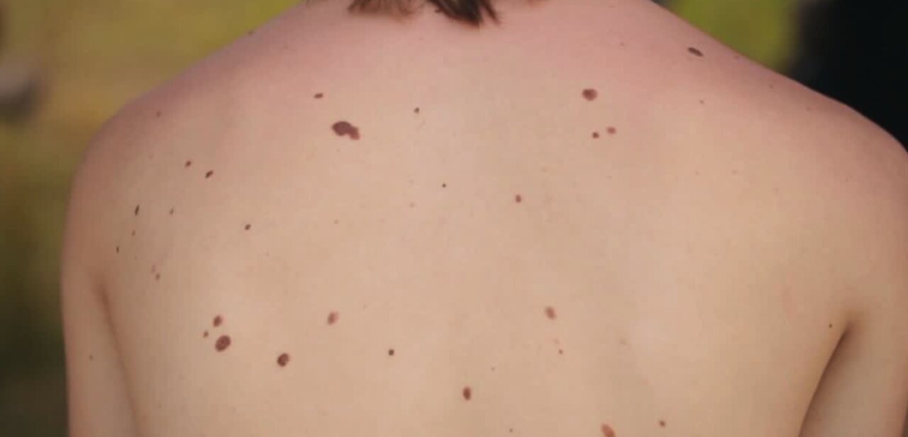 Dermatologist shares warning signs of melanoma