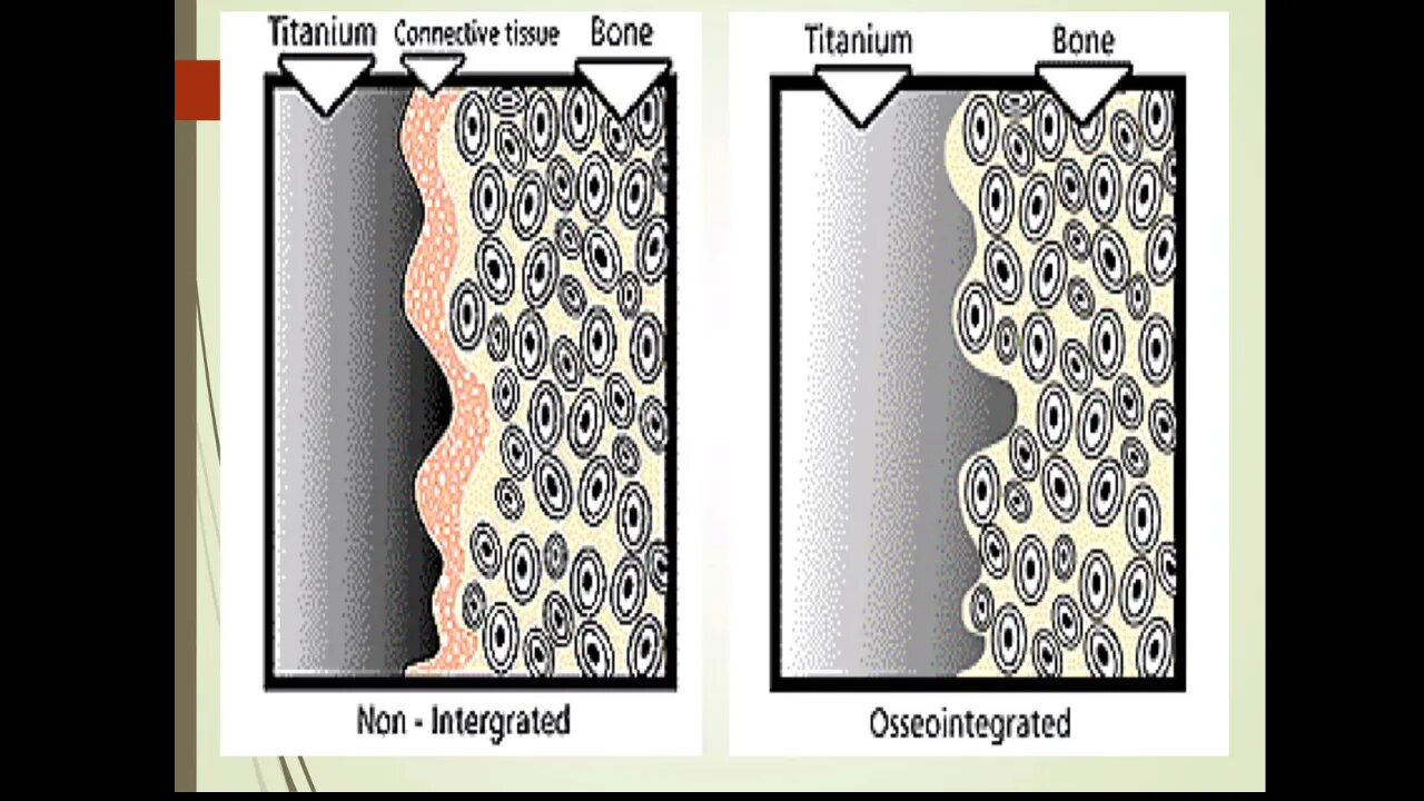 Periodontics L6 (Dental Implant)