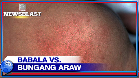 Health expert, nagpaalala para iwas bungang araw ngayong tag-init ang mga kabataan