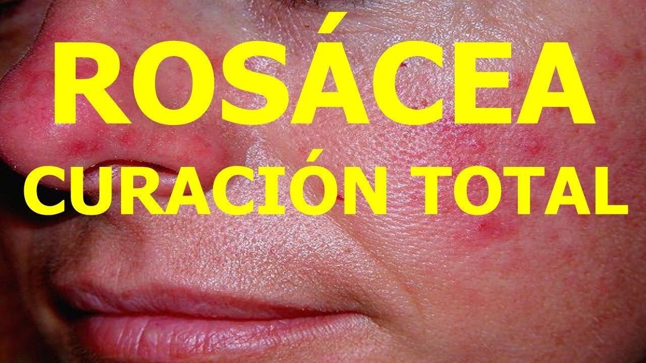 ELIMINAR LA ROSACEA DEFINITIVAMENTE LA ENFERMEDAD DE LA VERGUENZA BIODESCODIFICACION