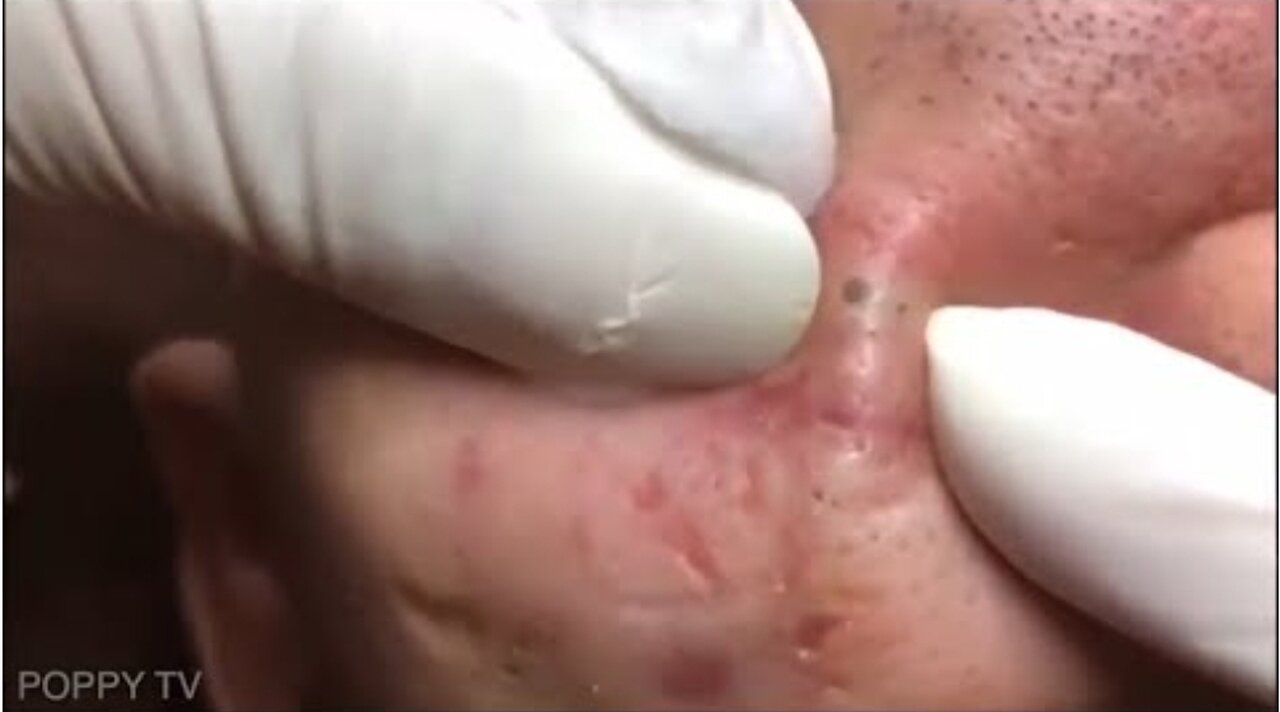 Blackheads Removal Pimple Popping Satisfying Videos