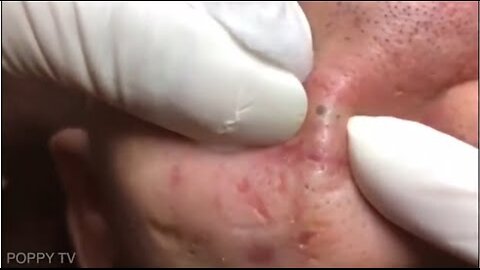 Blackheads Removal Pimple Popping Satisfying Videos