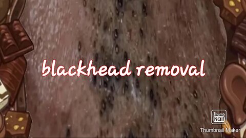Blackhead removal satisfying video #1