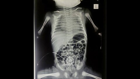 Sudden ____ Death Syndrome
