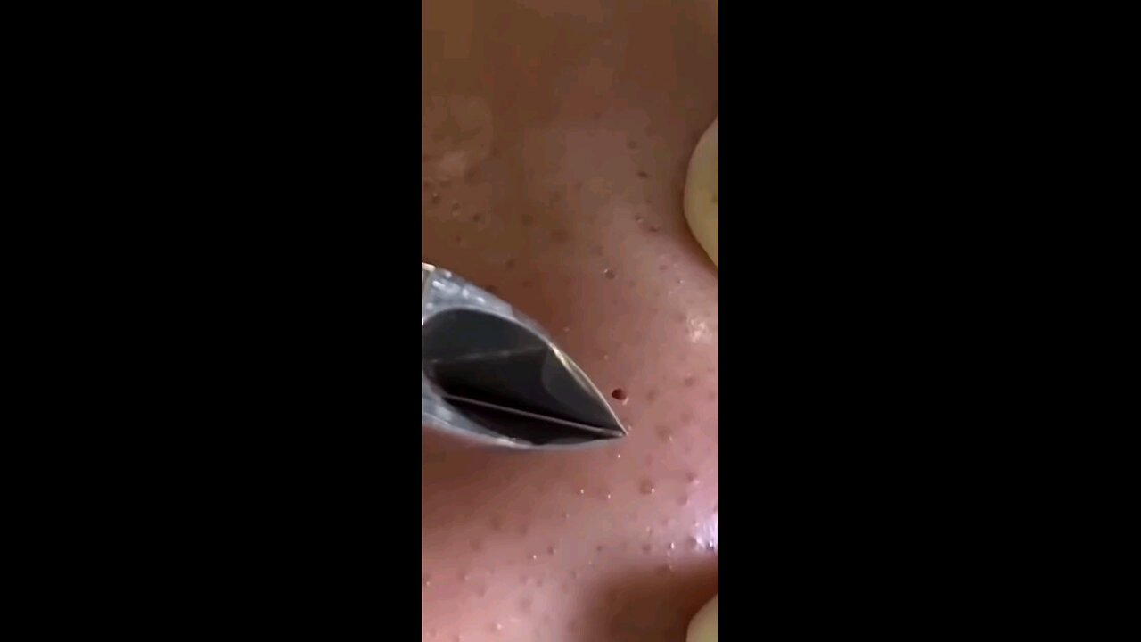 Blackheads episode 39