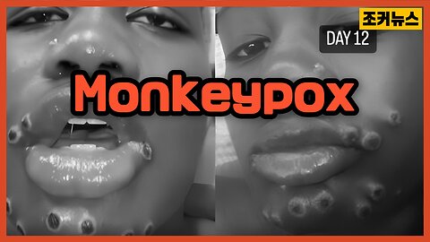 원숭이두창 Monkeypox -Joker News