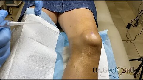 Drainage of knee bursitis