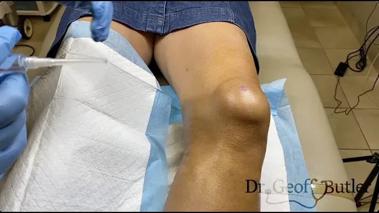 Drainage of knee bursitis