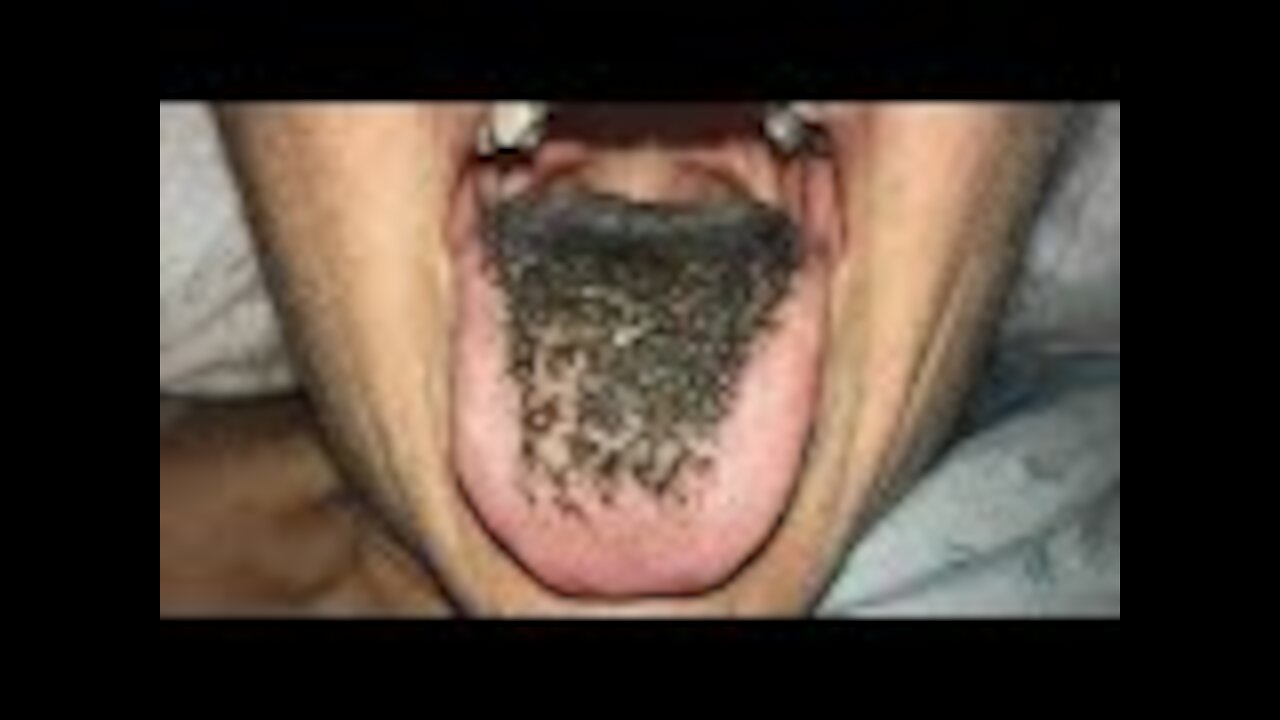 Some People Are Waking Up With Black Tongues